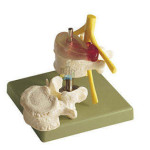 Dorsolaterle Disc Hernia Model